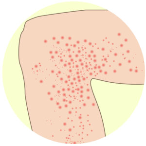 そのかゆみ、本当にアトピー？見落とされがちな“もう一つの可能性”